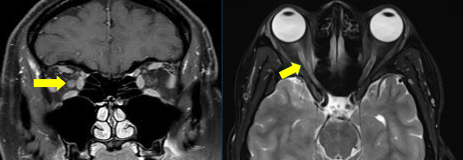 MRI Images- T2W hyperintensity is noted along Intra- orbital & intracanalicular segment of the right optic nerve