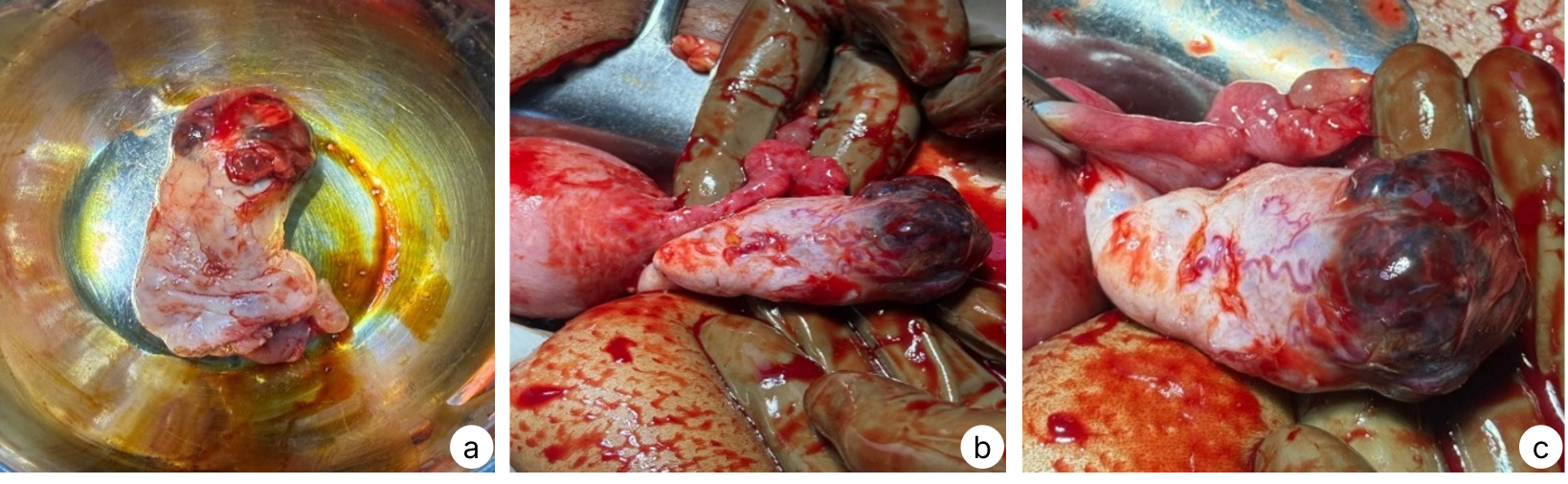 Operative findings showing (a) gross specimen following excision of the right ovarian ectopic pregnancy demonstrating gestational sac tissue with haemorrhagic trophoblastic components, (b) highly vascular haemorrhagic gestational mass arising from the right ovary and (c) close-up view demonstrating ovarian implantation with the ipsilateral fallopian tube appearing separate from the ectopic gestation
